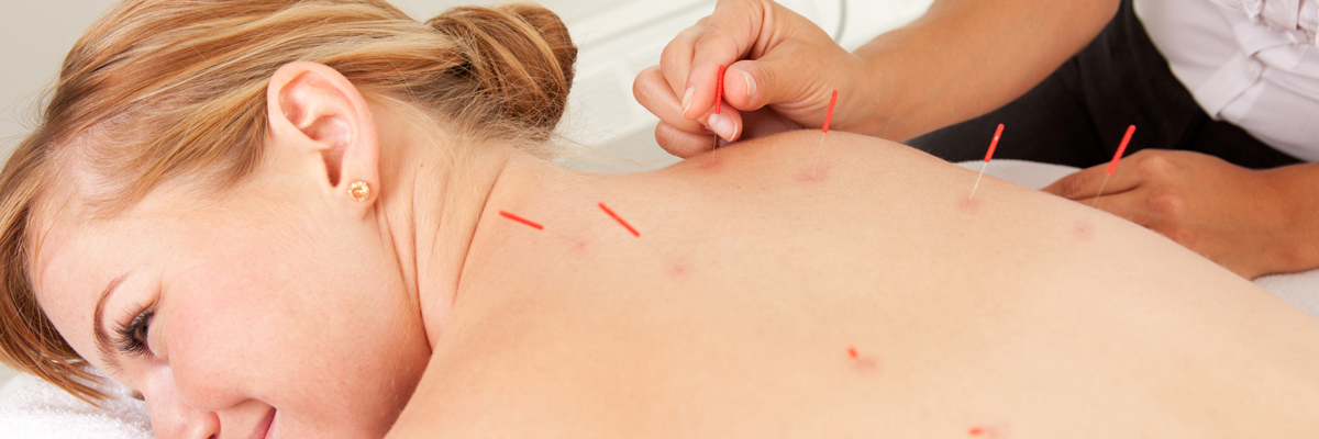 Acupuncture